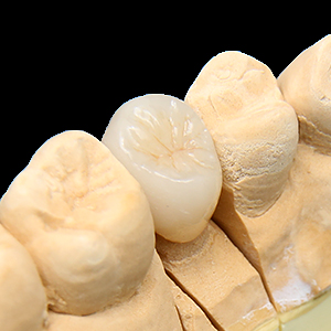 審美セラミック治療 | 診療案内 | 県庁前デンタルクリニック｜千代県庁